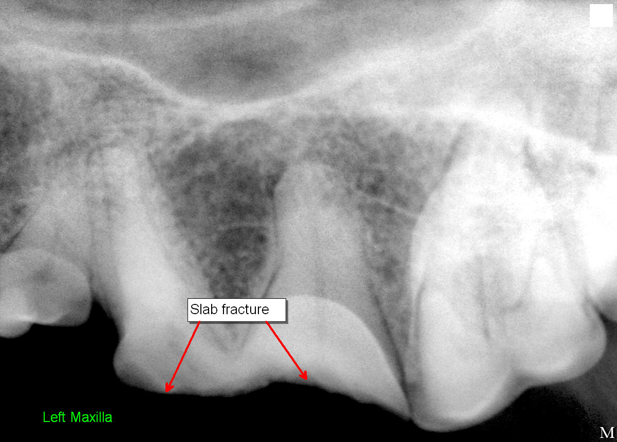 Dental X-Ray